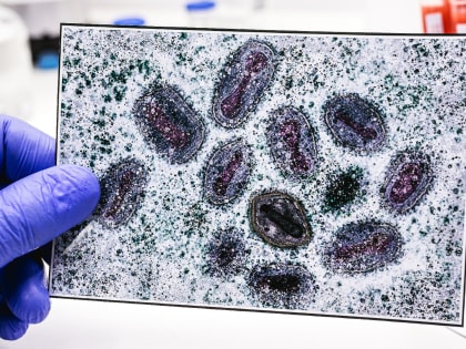 Два жителя Воронежской области госпитализированы с сибирской язвой