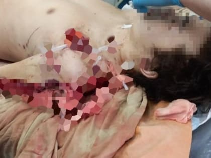 У раненого тигром охотника поднялась температура, отказывают органы - хабаровские врачи