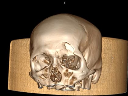 Хабаровские врачи восстановили пациенту череп