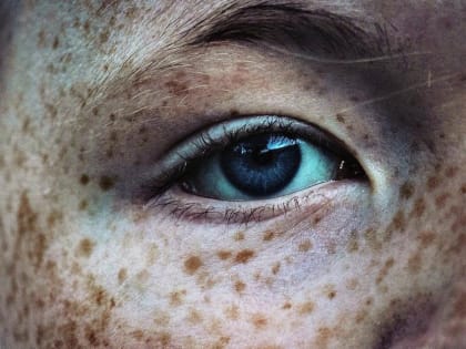 Хабаровчан зовут проверить родинки на онкопатологию