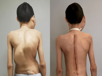 Российские врачи первые в мире выправили позвоночник у пациента с синдромом Протея