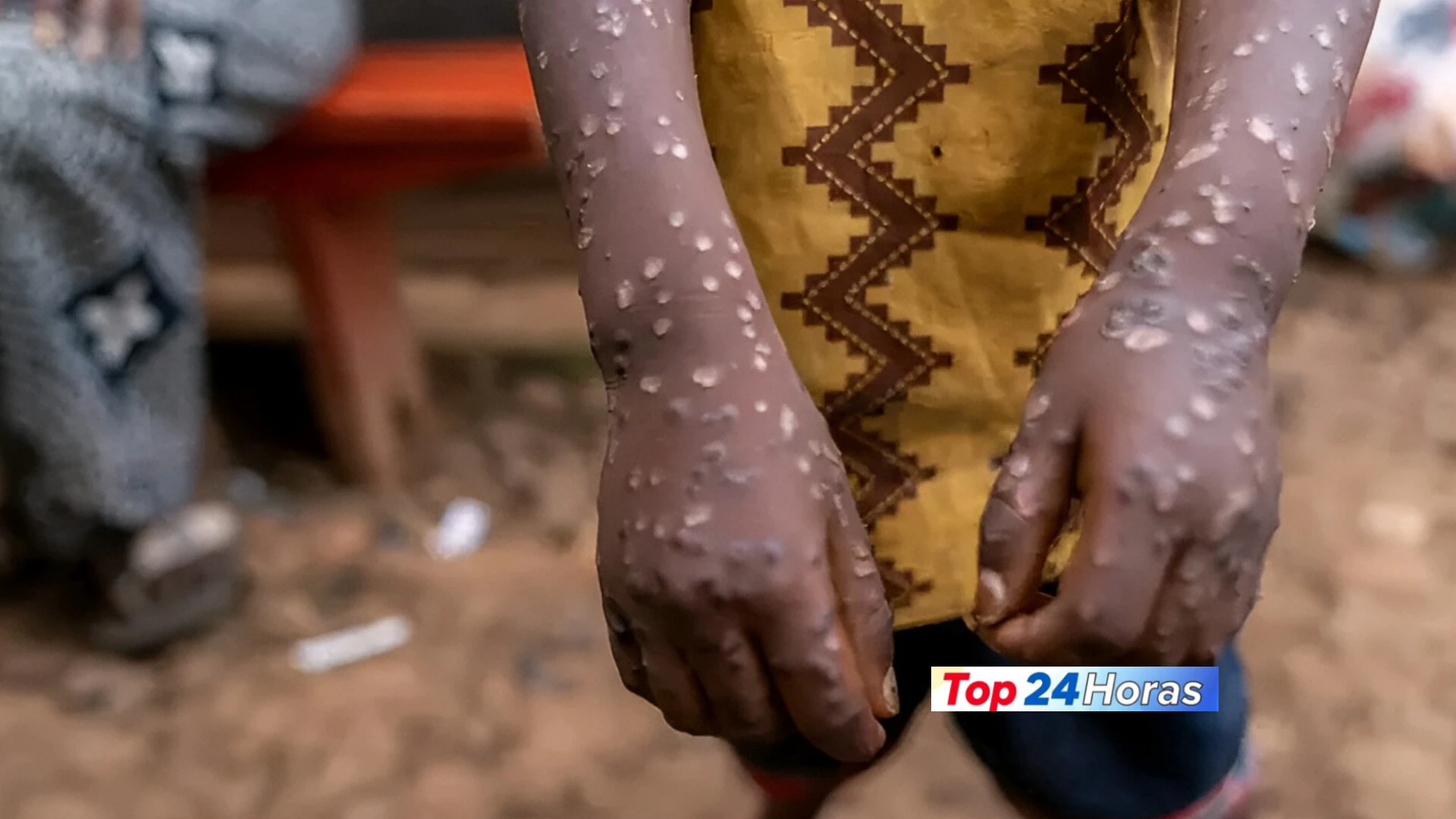 Primeiro Caso de MPOX em Cabo Delgado: Medidas de Prevenção Urgentes