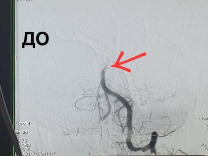 В Оренбурге хирурги удалили 59-летнему пациенту тромб в базилярной артерии мозга