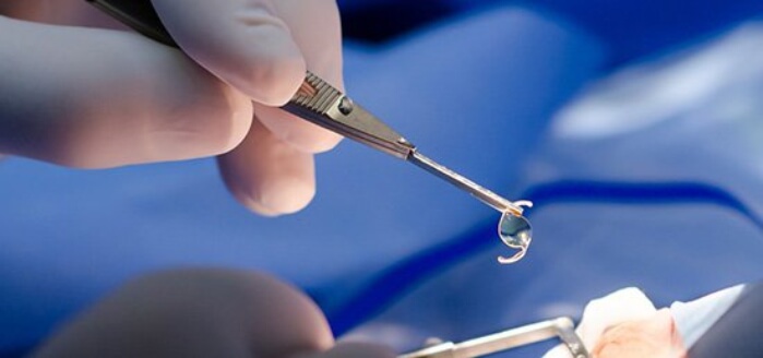Imagem de uma cirurgia para implante de lente intraocular