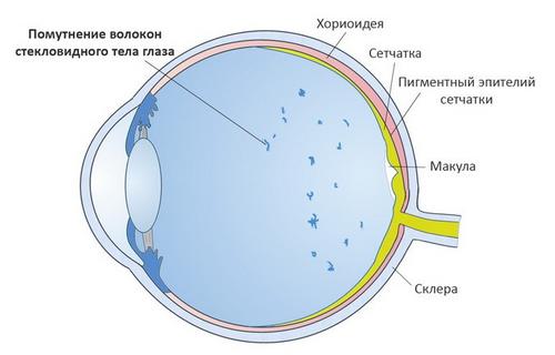 Можлива причина появи плям перед очима Можлива причина появи плям перед очима