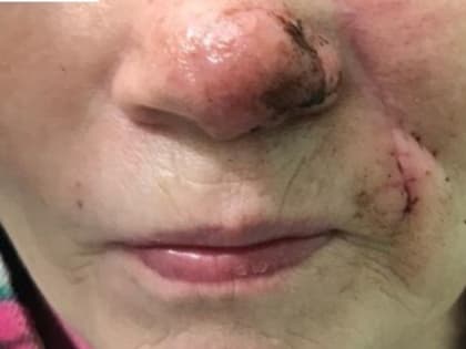 Нижегородские хирурги восстановили пациентке полностью откушенный собакой нос