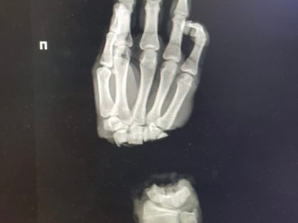 Нижегородские врачи спасли руку 16-летнему подростку