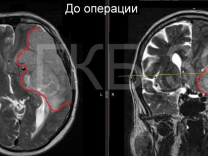 Нейрохирурги ГКБ №39 удалили нижегородцу гигантскую опухоль головного мозга