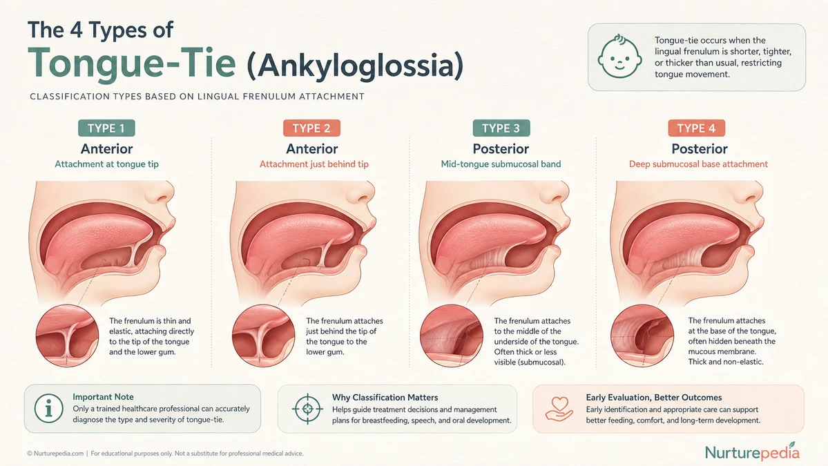 Medical infographic diagram illustrating Type 1 to Type 4 anterior and posterior infant tongue-tie classifications.