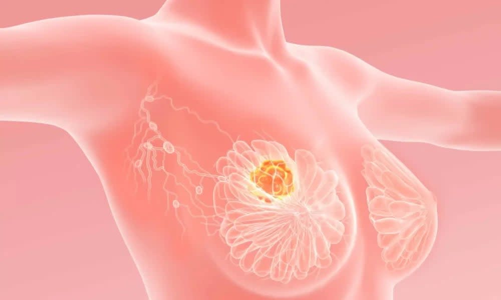 medicament pentru tratament cancer de sân HER2-pozitiv