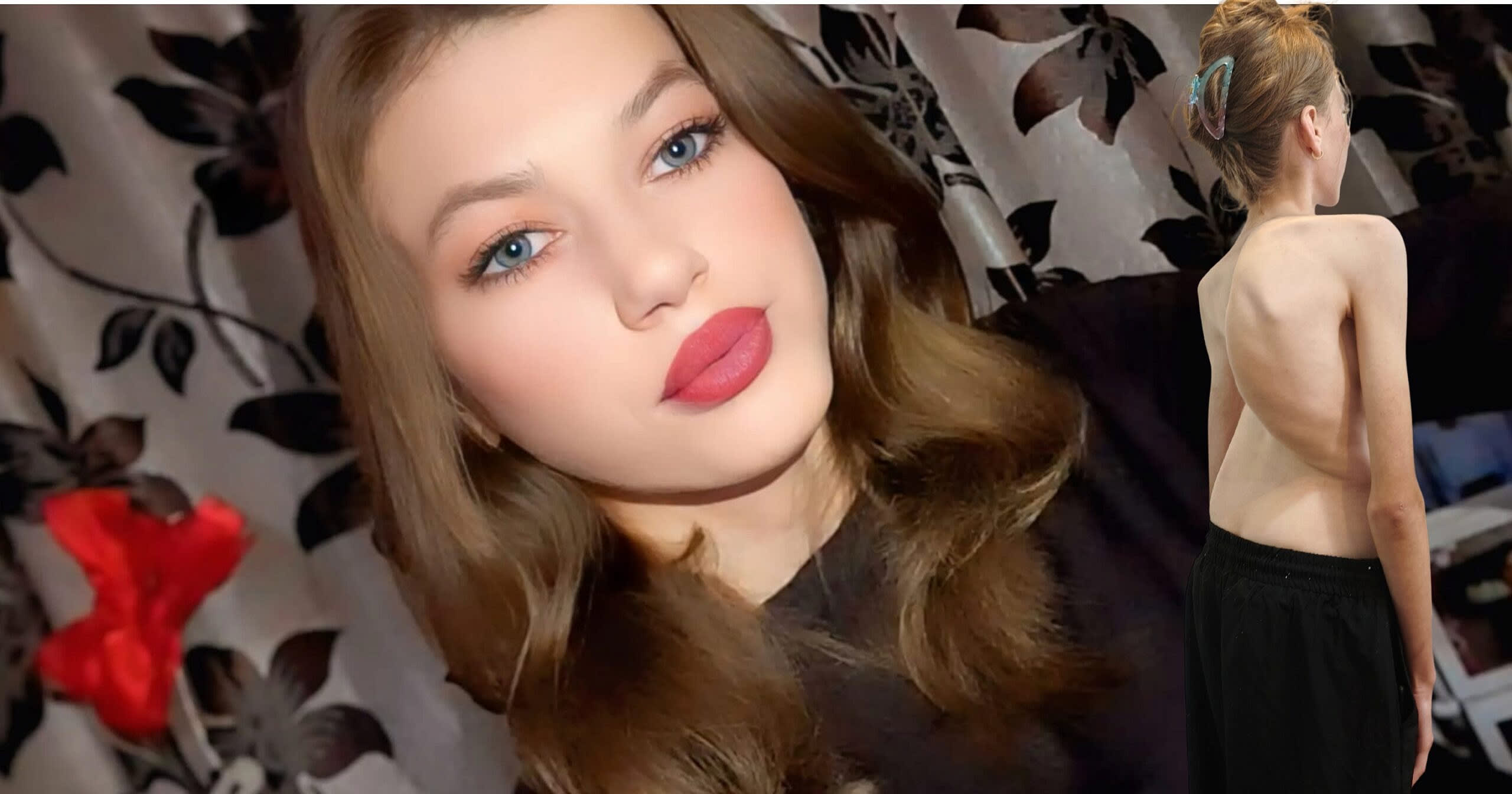 Denisa Catană, adolescentă cu scolioză, apel umanitar Denisa Catană, adolescentă cu scolioză, apel umanitar