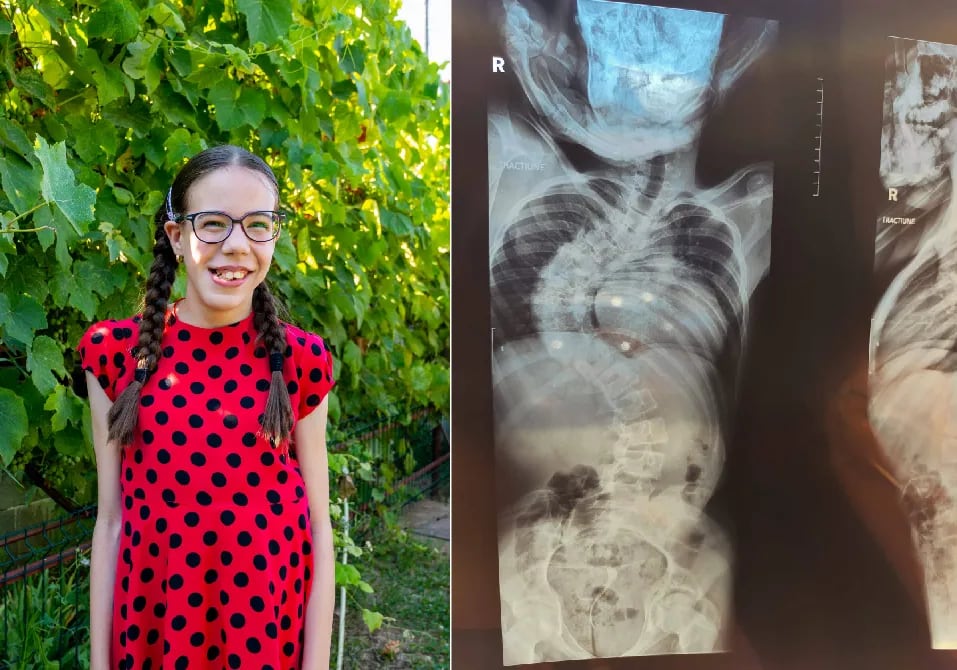Fetiță de 13 ani cu scolioză severă, în spital, însoțită de mama sa Fetiță de 13 ani cu scolioză severă, în spital, însoțită de mama sa