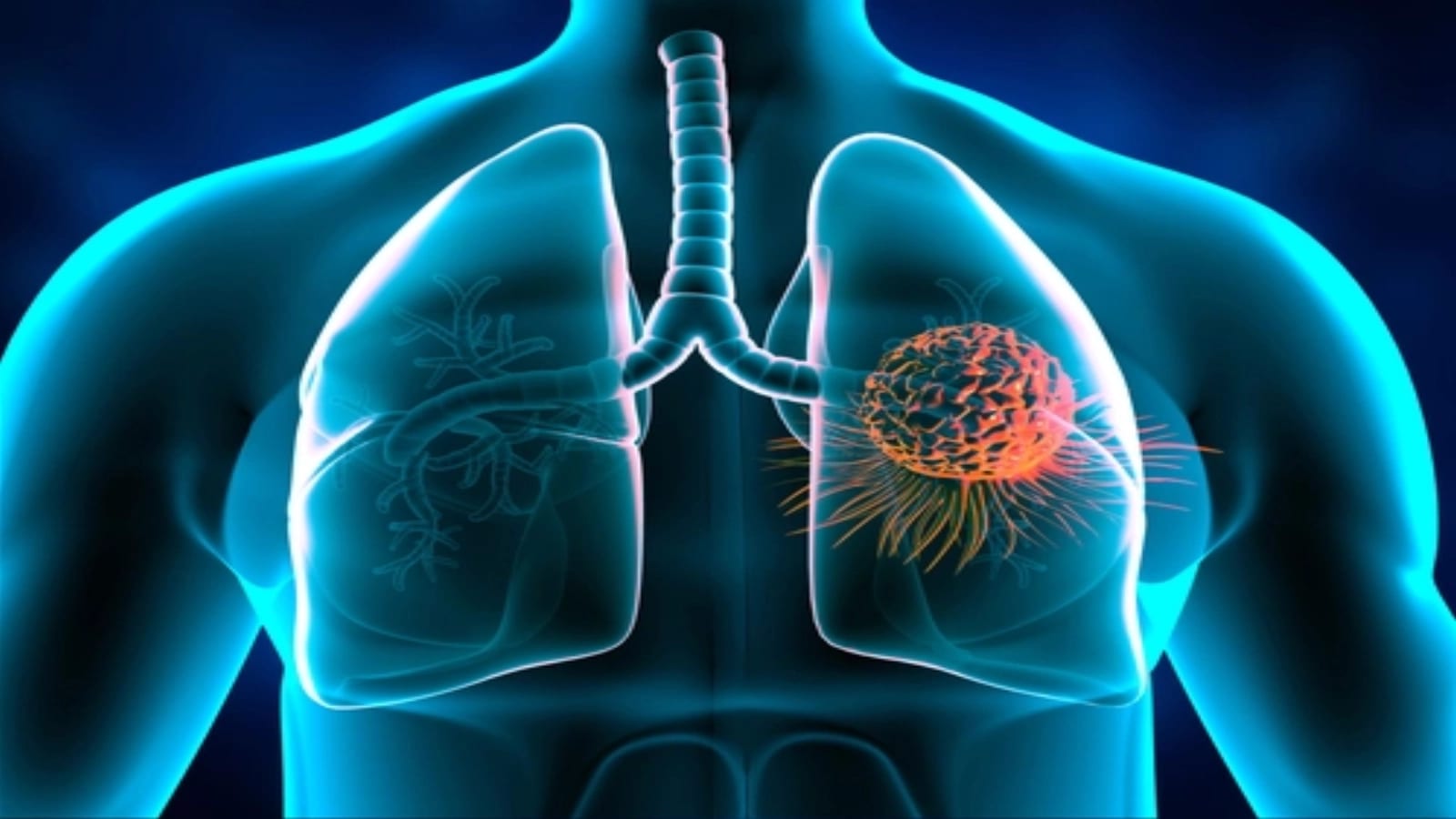 tratament cancer pulmonar, anticorp bispecific, studiu clinic