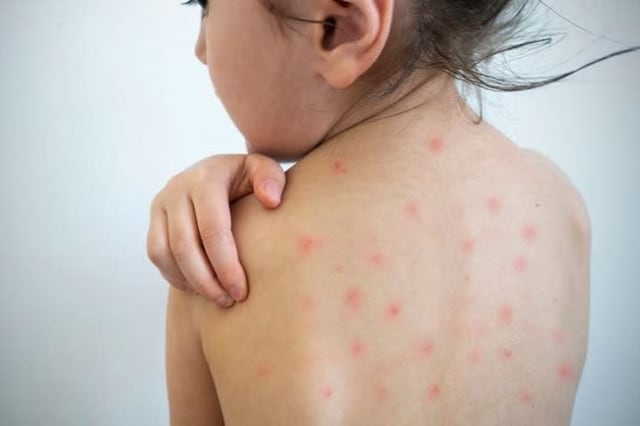 Creștere alarmantă a cazurilor de rujeolă în Europa și Asia, inclusiv în România