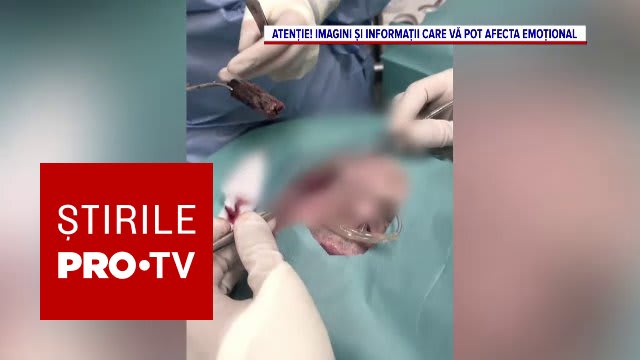 Un pacient din Baia Mare a descoperit bucăți de lemn în față după o intervenție medicală