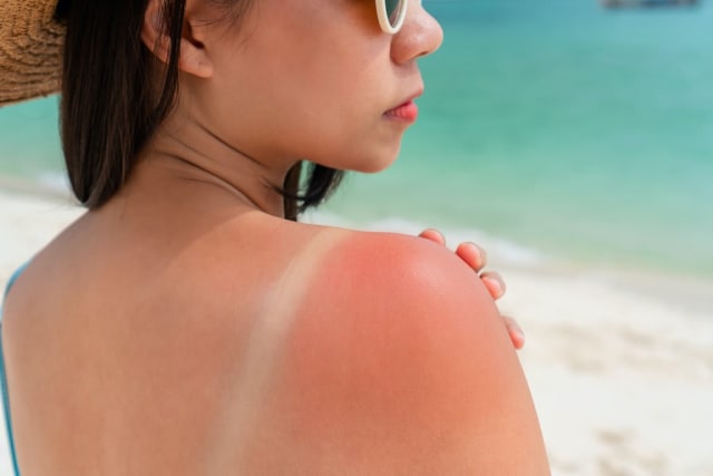Arsurile solare din copilărie pot duce la cancer de piele, avertizează specialiștii