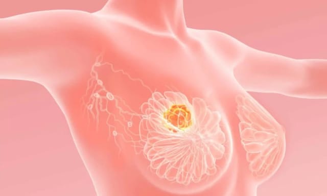 UE a aprobat o nouă terapie de primă linie pentru cancerul mamar HER2-pozitiv