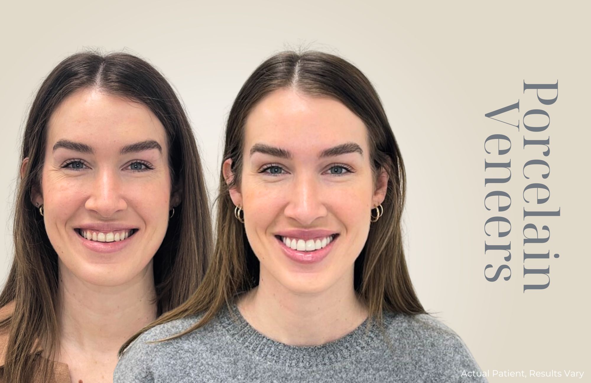 Before-and-after portrait of a woman showcasing a brighter smile with porcelain veneers.