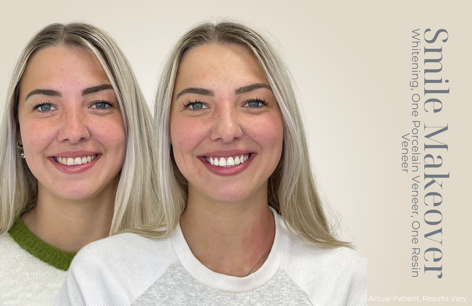 Before-and-after photo of a woman showcasing whiter teeth and a brighter smile after cosmetic dental work.