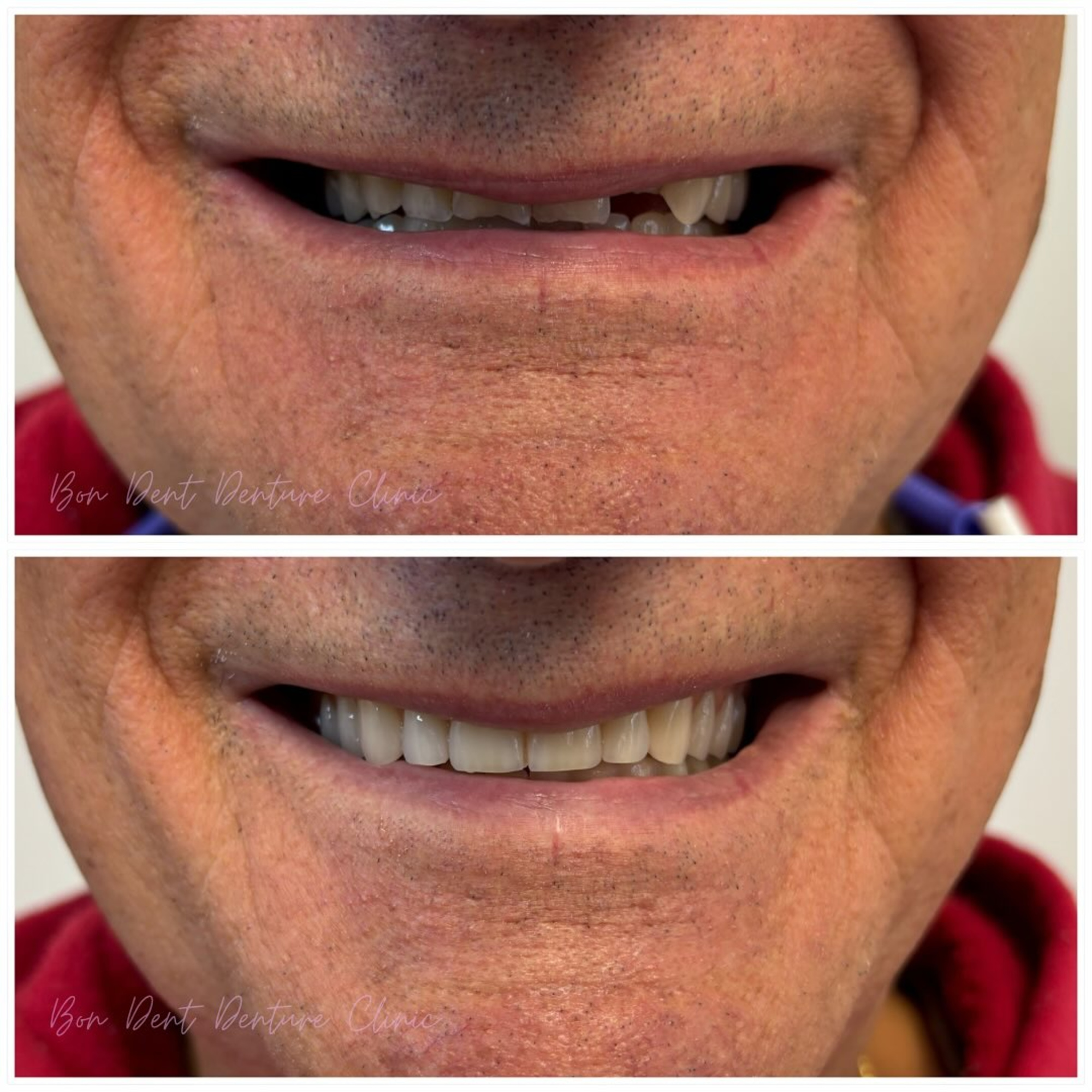 Before and after close-up of an improved smile showing whiter, straighter teeth.