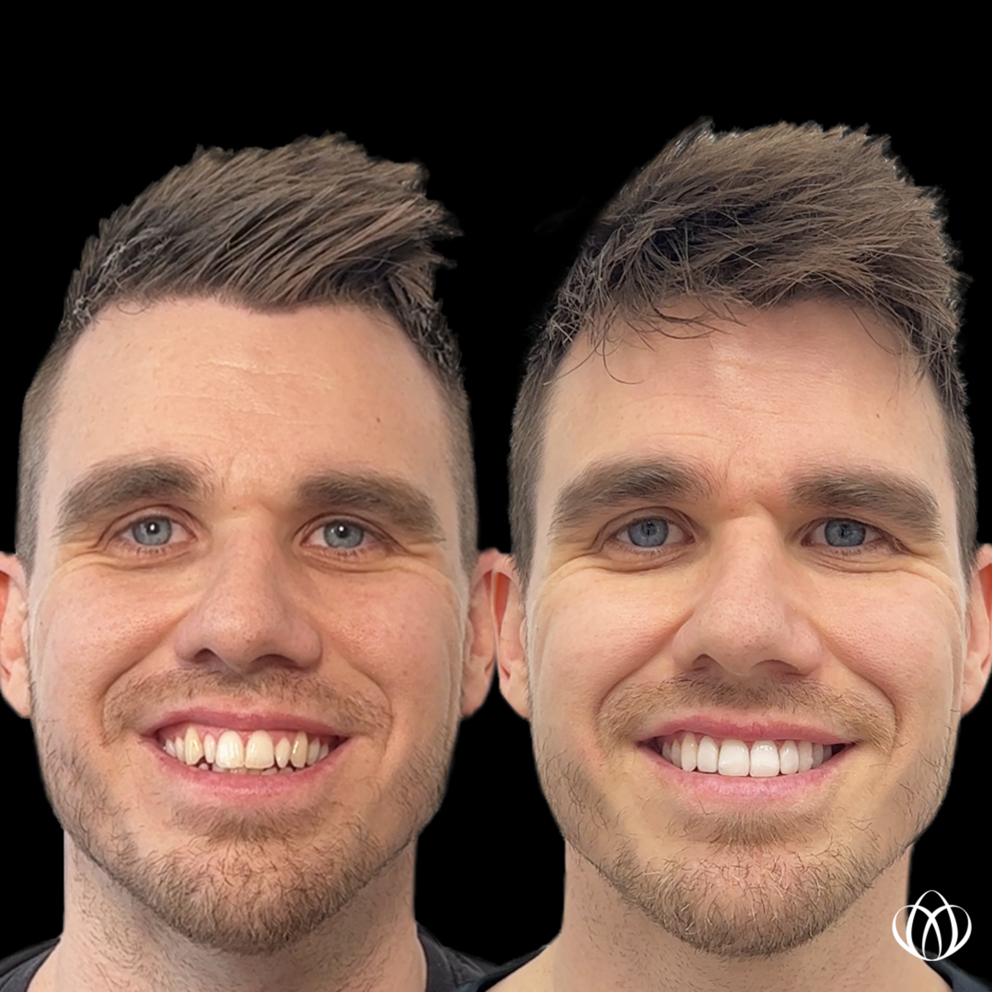 Side-by-side before and after close-up of a smiling man showing improved teeth against a black background.