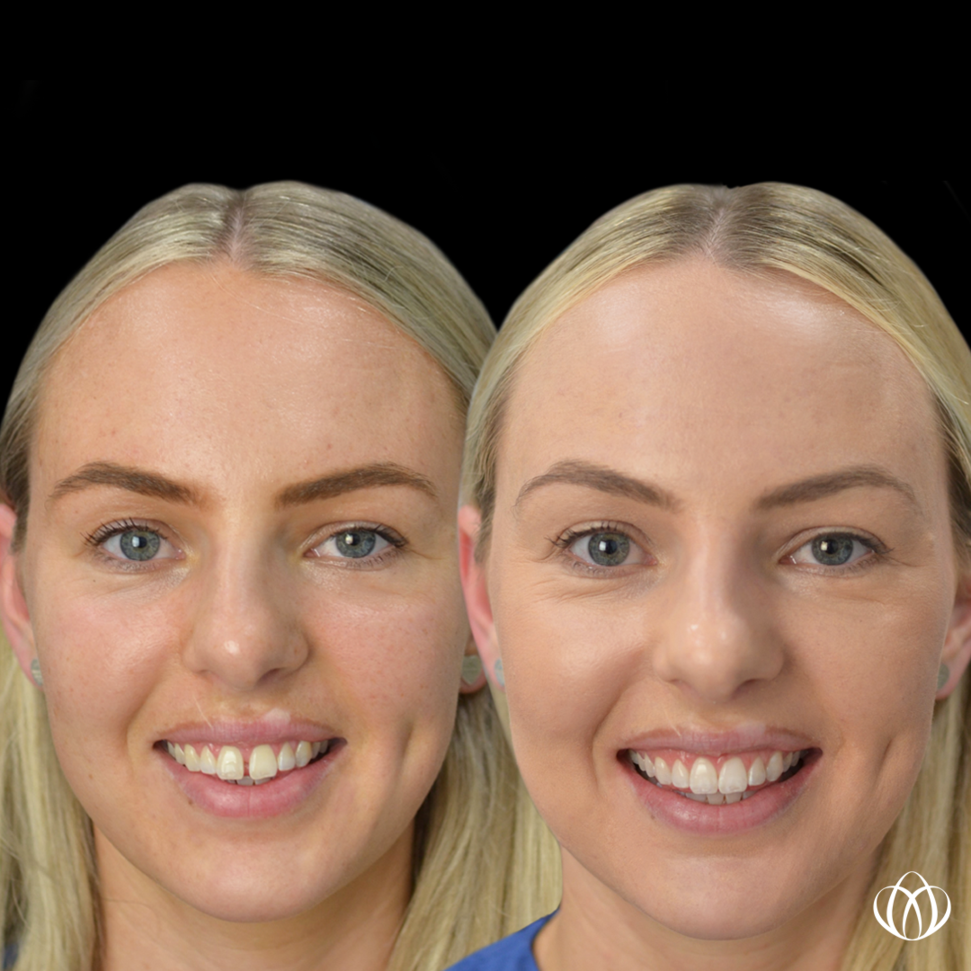 Side by side bridal beauty before and after portrait showing cosmetic dental and makeup enhancements for a wedding-ready smile.