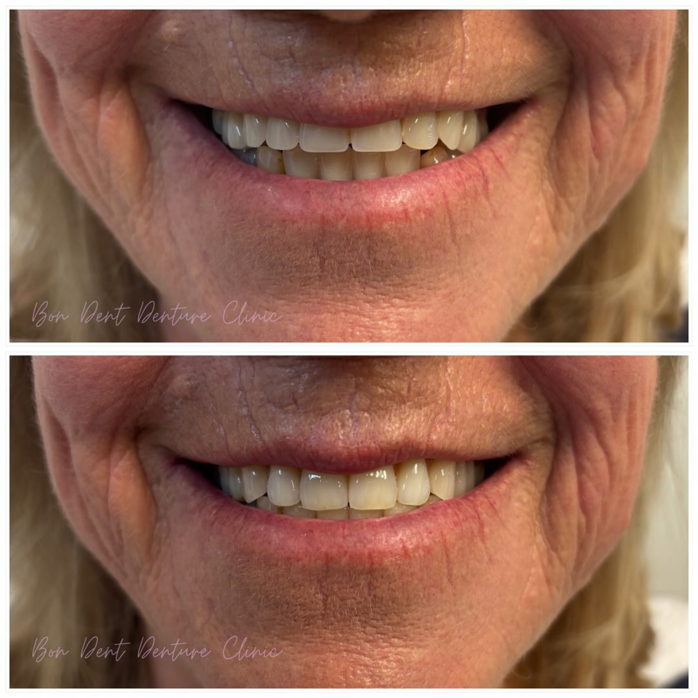 Close-up before and after photos showing improved dentures and a brighter smile.