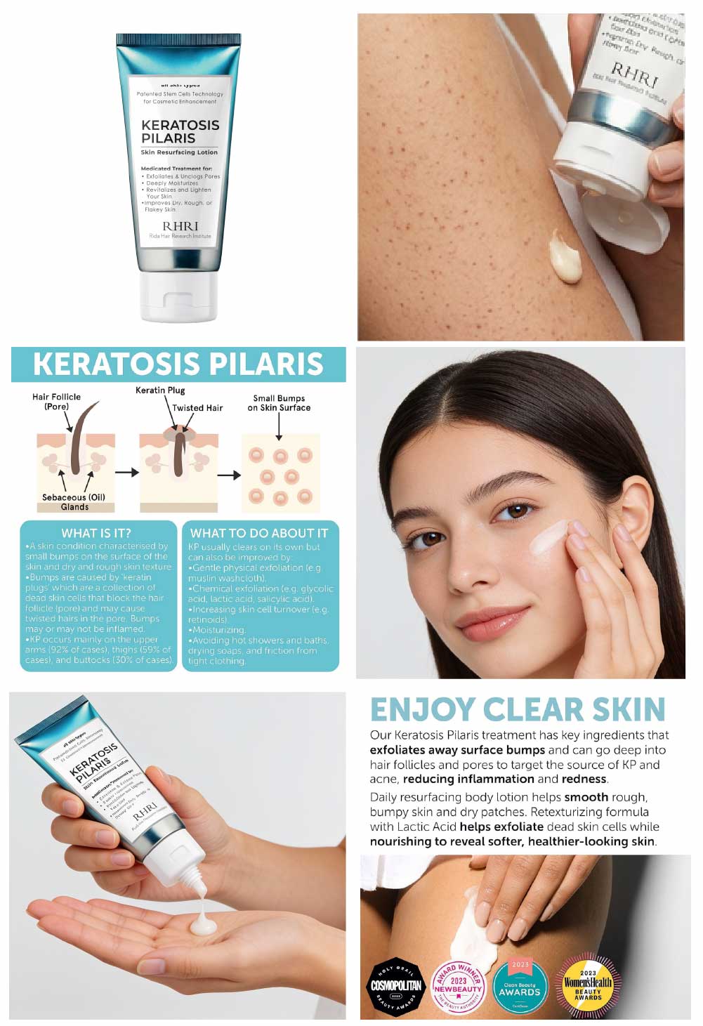 Keratosis Pilaris Lotion with 10% AHA - before