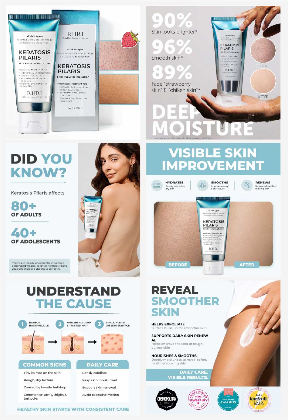 Keratosis Pilaris Lotion with 10% AHA - after