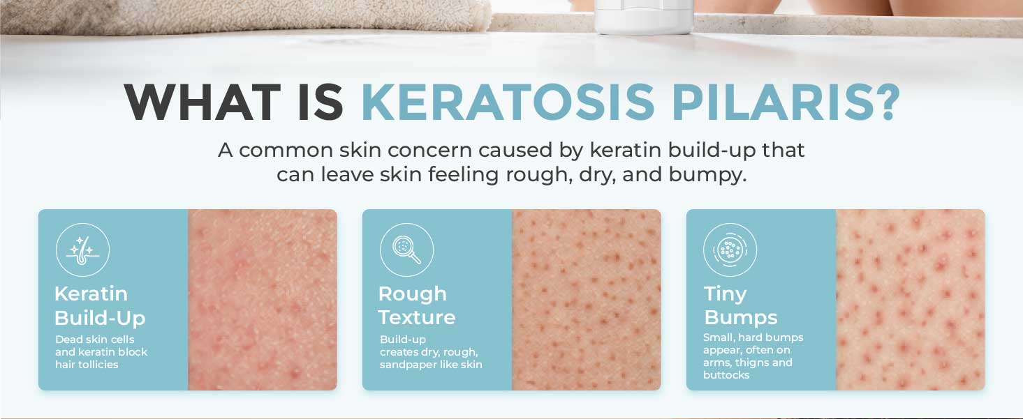 What Is Keratosis Pilaris?