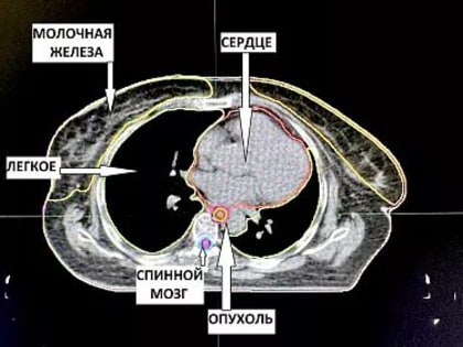 Опухоль сложной локализации удалили тульские врачи 66-летней пациентке из Узловой