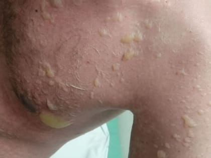 В Туле врачи спасли жизнь пациенту с токсическим синдромом Лайелла