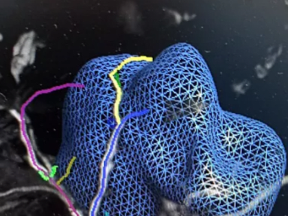 Тульские онкологи впервые провели уникальную операцию на печени