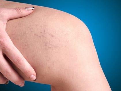 Врачи рассказали о защите от варикозного расширения вен