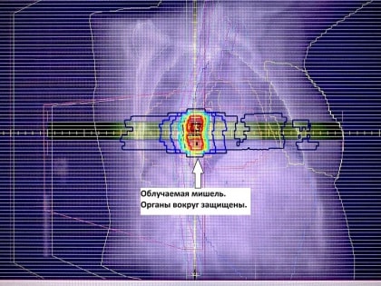 В Тульской области пенсионерке удалили сложную опухоль
