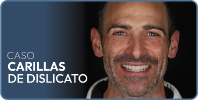 Caso implantes dentales carga inmediata