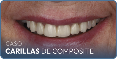 Caso implantes dentales carga inmediata