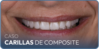 Caso implantes dentales carga inmediata
