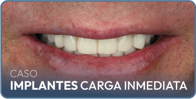 Caso implantes dentales carga inmediata