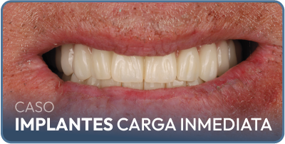 Caso implantes dentales carga inmediata