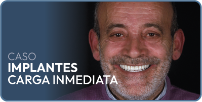 Caso implantes dentales carga inmediata