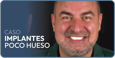 caso-implantes-poco-hueso Caso implantes dentales carga inmediata
