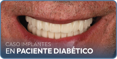 Caso implantes dentales carga inmediata