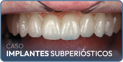 Caso implantes subperiósticos