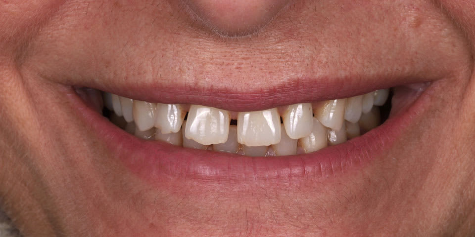 Antes