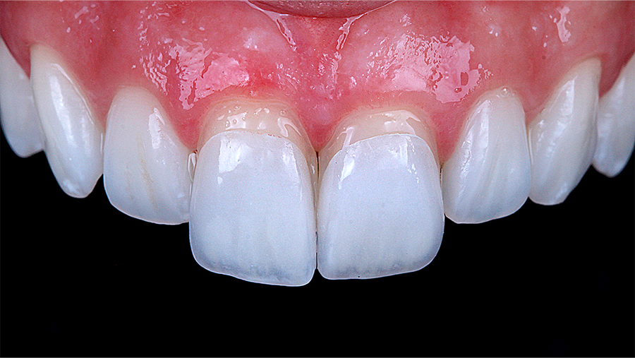 carillas-dentales-precio