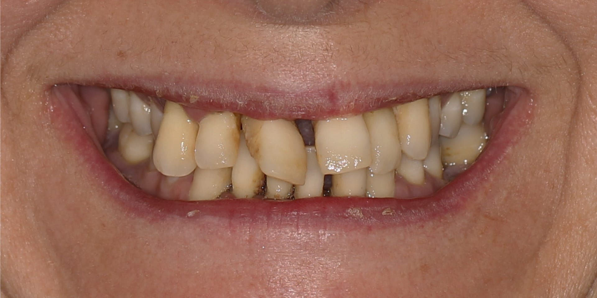 Antes