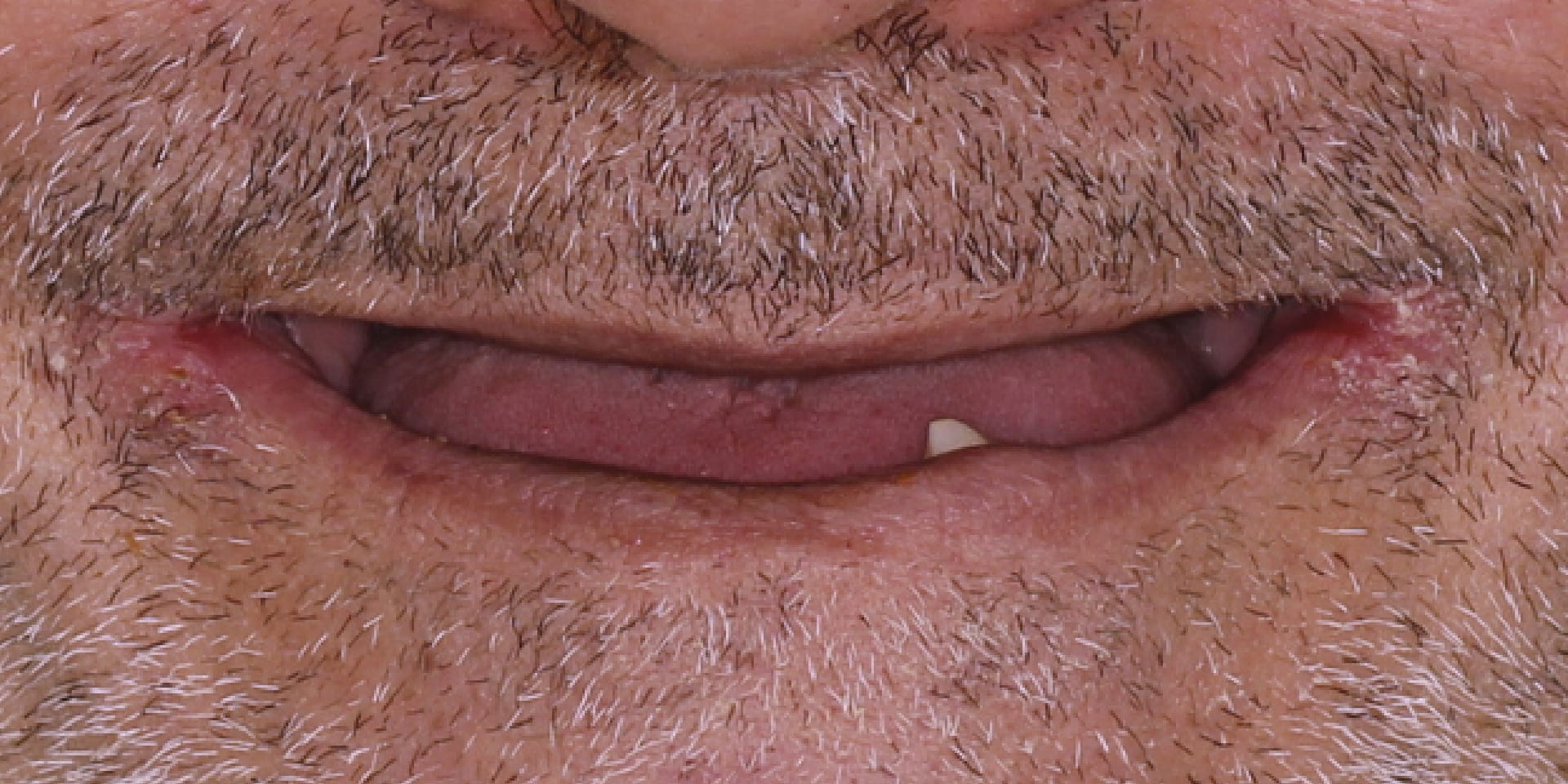 Antes