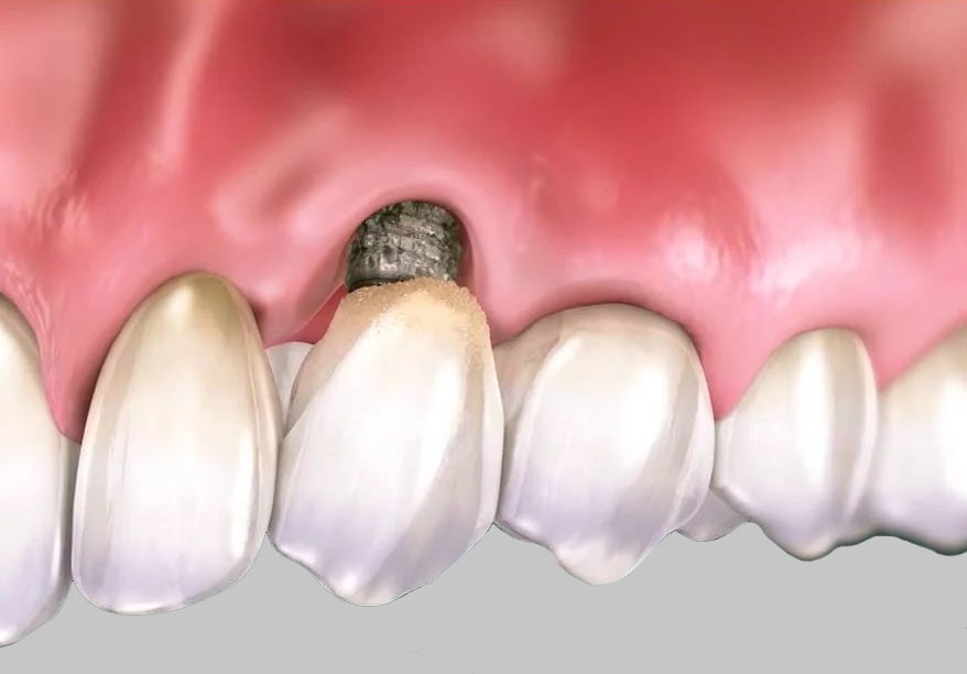 rechazo implante dental