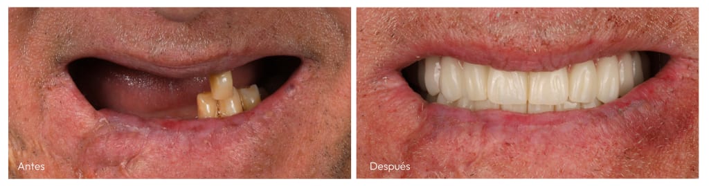 caso real implantes dentales madrid